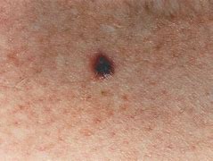 Image result for Stage 4 Metastatic Melanoma Weight Gain