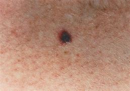 Image result for Early Melanoma in Situ