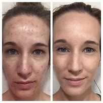 Image result for Arbonne Skin Elixir Before and After