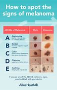 Image result for Early Melanoma Mole Pic