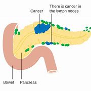 Image result for Pancreatic Cancer Anatomy