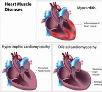 Image result for Noonan Syndrome Heart