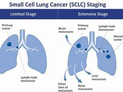 Image result for Extensive Stage Small Cell Lung Cancer