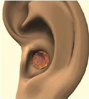 Image result for Ear Wax Infection