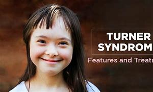 Image result for Mosaic Turner Syndrome in Girls