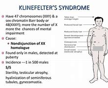 Image result for Klinefelter's Symptoms