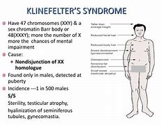 Image result for Klinefelter's Syndrome and Depression