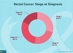 Image result for Stage 4 Rectal Cancer