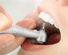 Image result for What Is a Dental Restoration