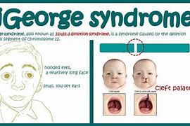 Image result for Syndrome S Difoerge