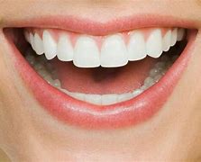 Image result for White Tartar On Teeth