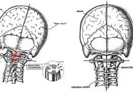 Image result for Woke Up with Neck Pain