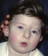 Image result for Prader-Willi Syndrome Pictures Infant