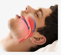 Image result for Home Remedies for Obstructive Sleep Apnea