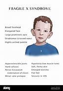 Image result for Fragile X Syndrome Adults