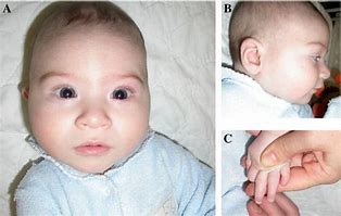 Image result for Feingold Syndrome