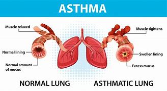 Image result for Asthma and Bronchitis