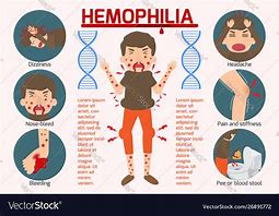 Image result for Hemophilia Patients