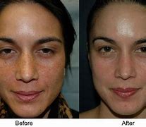 Image result for Vitamin C Peel Before and After