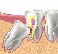 Image result for Impacted Wisdom Teeth