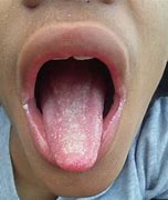 Image result for Chronic Mucocutaneous Candidiasis