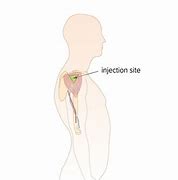 Image result for IM Injection Arm
