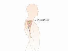 Image result for Intramuscular Injection Diagram