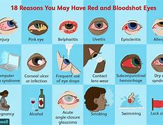 Image result for Bloodshot Eyes Treatment