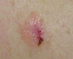Image result for Red Melanoma Pictures