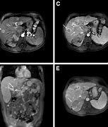 Image result for Cullen's Sign Pancreatitis