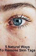 Image result for Eye Remove Skin Tags