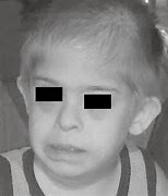 Image result for Klinefelter's Syndrome Eye