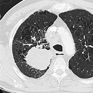 Image result for Stage 4 Small Cell Lung Cancer