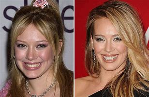 Image result for Hilary Duff Teeth Veneers Before and After