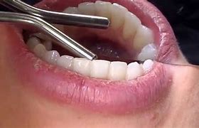 Image result for Water Syringe Wisdom Teeth