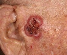 Image result for Squamous Cell Carcinoma