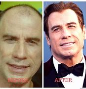 Image result for John Travolta Plastic Surgery Nightmare
