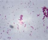 Image result for New Gonorrhea Superbug