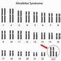 Image result for Klinefelter Syndrome Signs