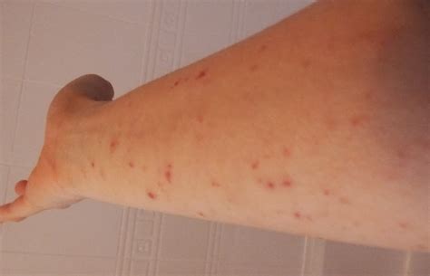 I Have Eczema  December Skin  Day 205 TSW