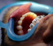Image result for Mettre Les Dents