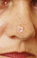 Image result for Ulcerated Melanoma