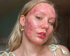 Image result for People with Blemishes