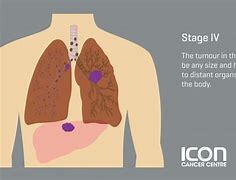 Image result for Stage 4B Lung Cancer