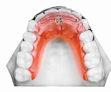 Image result for Removable Orthodontic Appliance with Z Spring