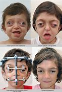 Image result for Crouzon Syndrome Before and After