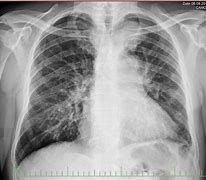 Image result for Small Cell Lung Cancer MRI