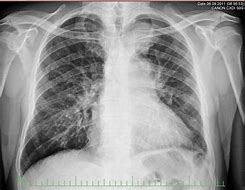 Image result for Small Cell Lung Cancer Paraneoplastic USMLE