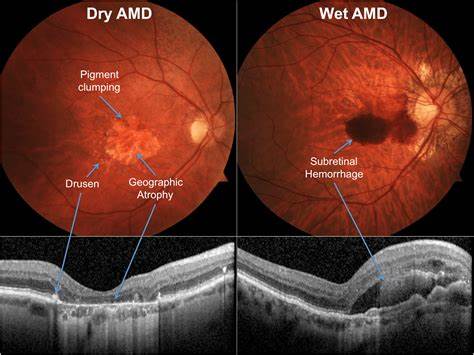 AMD Or Age-Related Macular Degeneration: Researchers Identify ...