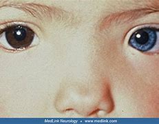 Image result for Waardenburg Goldenhar Syndrome